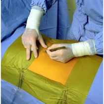 Ioban incisionsduk 60x60 cm /st